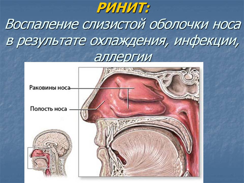 Полипы носа